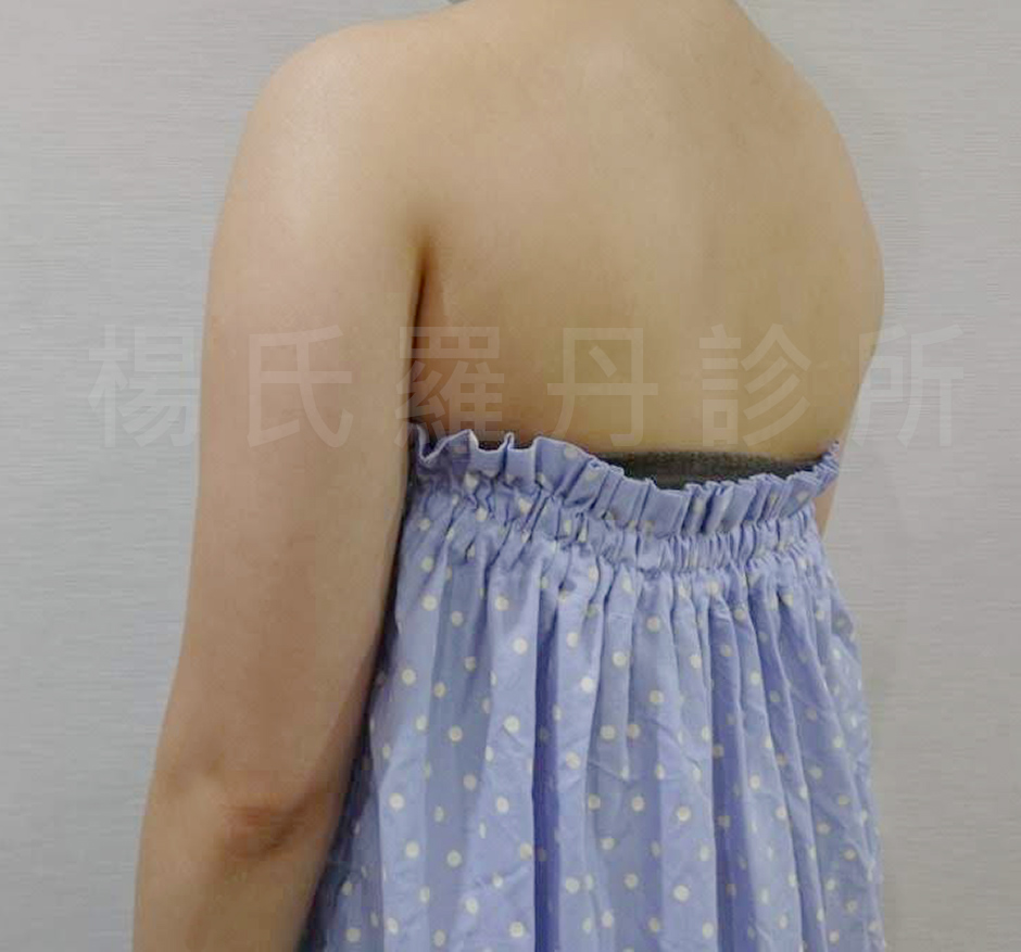 楊氏羅丹雷射減脂